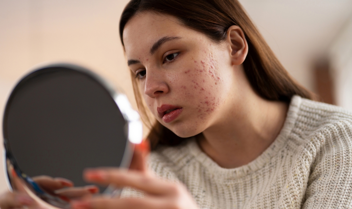 Treatment for acne skin with mild inflammation