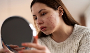 Gained in practice, for use in practice: Treatment for acne skin with mild inflammation