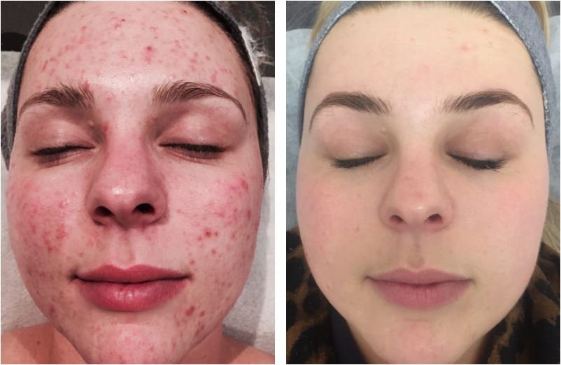 Before and after therapy of Acne