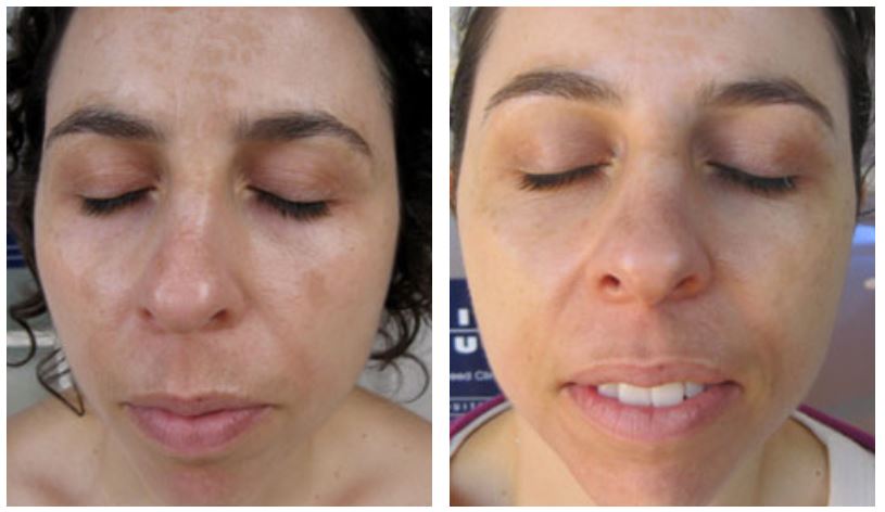 Pirms un pēc pigmentācijas ārstēšanas