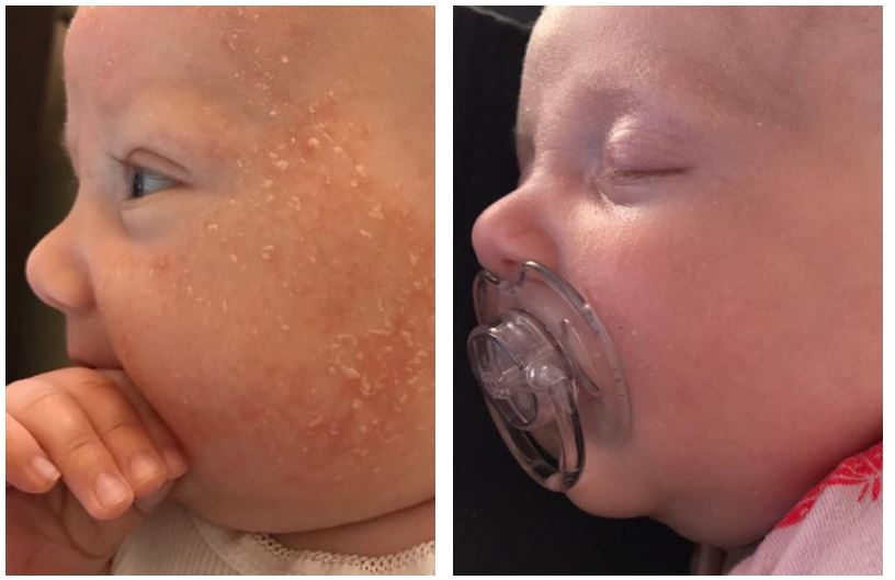 Before and after therapy of Eczema