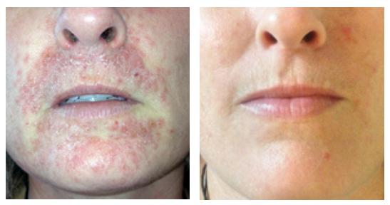Before and after therapy of Inflammatory Rash