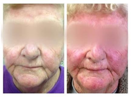Pirms un pēc ādas barjeras disfunkcijas ārstēšanas