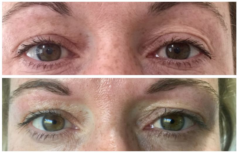 Before and after therapy of Anti-Ageing (Eye Area)