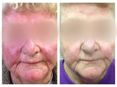 До и после терапии барьерной дисфункции кожи