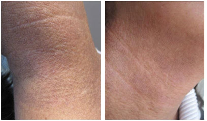 Before and after therapy of Impaired Barrier Disfuction - Neurodermatitis