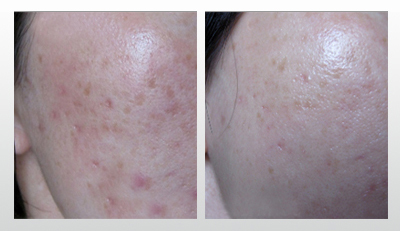 Before and after therapy of Post-Acne Scars