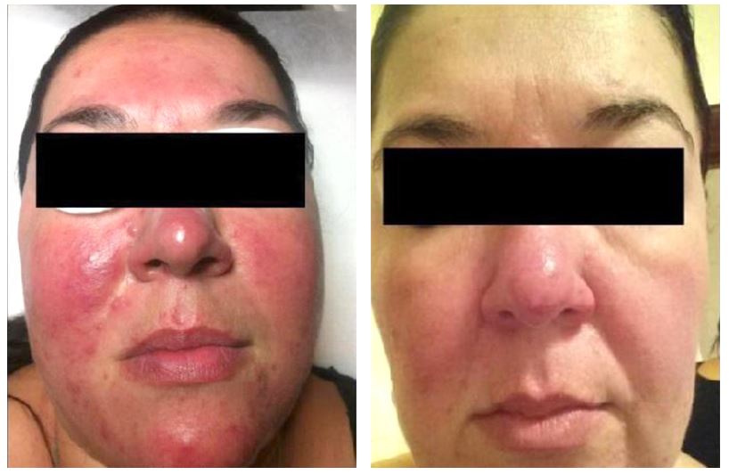 Before and after therapy of Rosacea