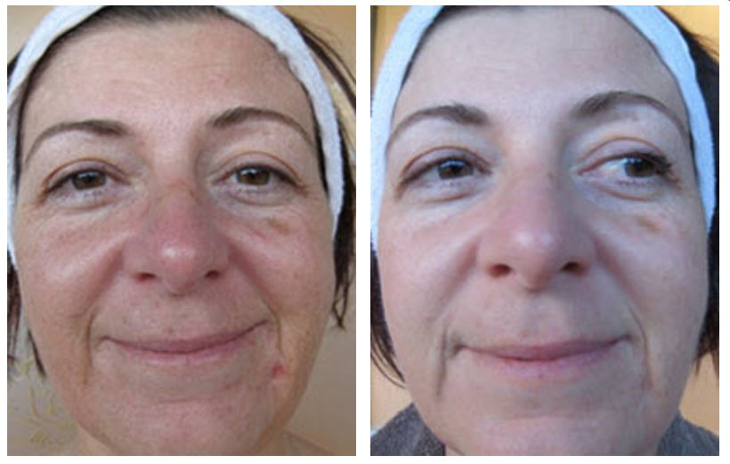 Before and after therapy of Anti-Ageing